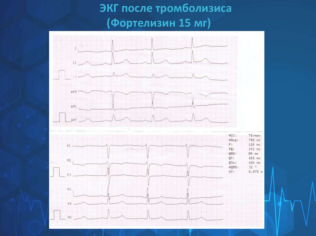 ЭКГ после тромболизиса (Фортелизин 15 мг)
