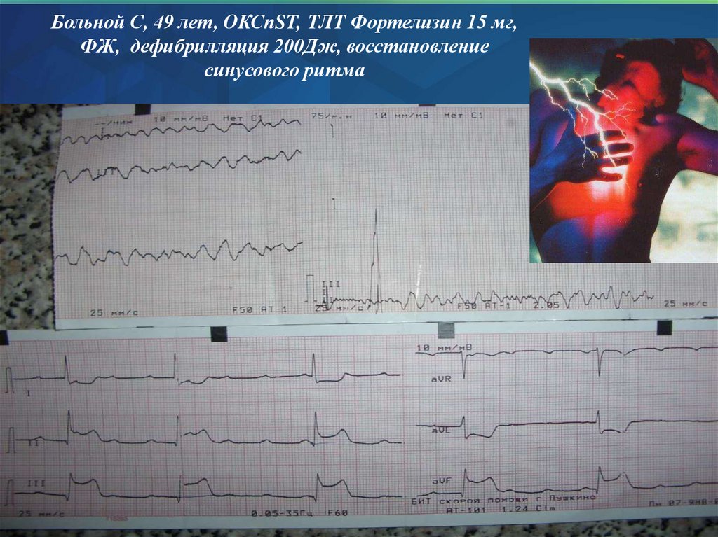 Больной С, 49 лет, ОКСпST, ТЛТ Фортелизин 15 мг, ФЖ, дефибрилляция 200Дж, восстановление синусового ритма