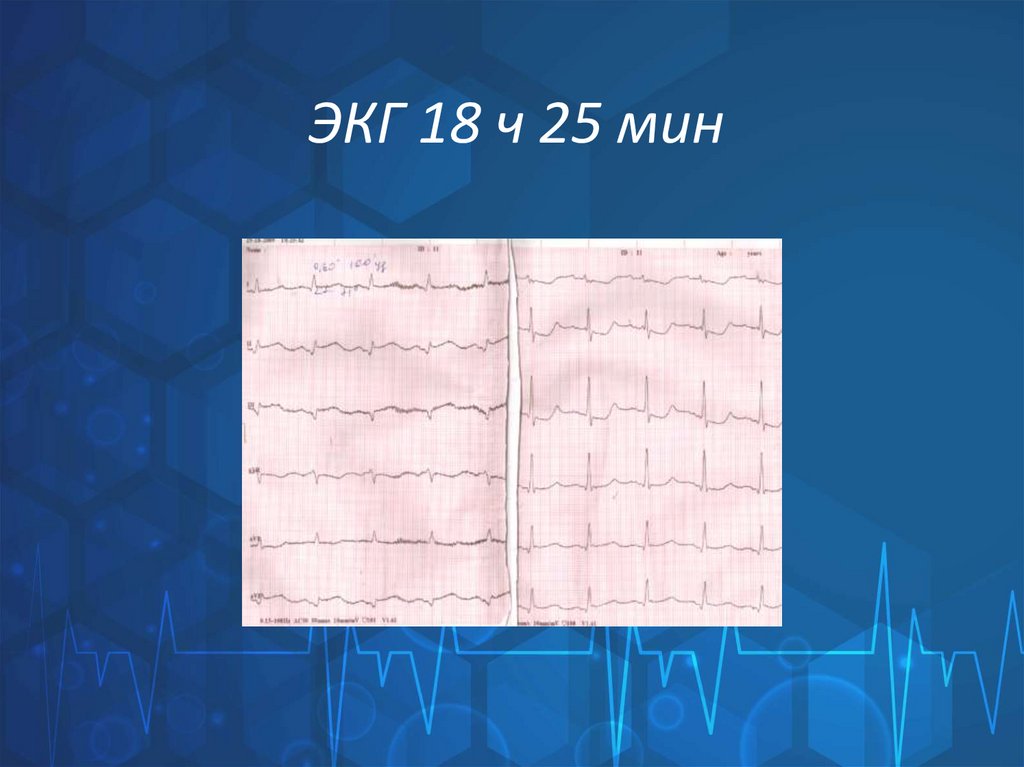 ЭКГ 18 ч 25 мин