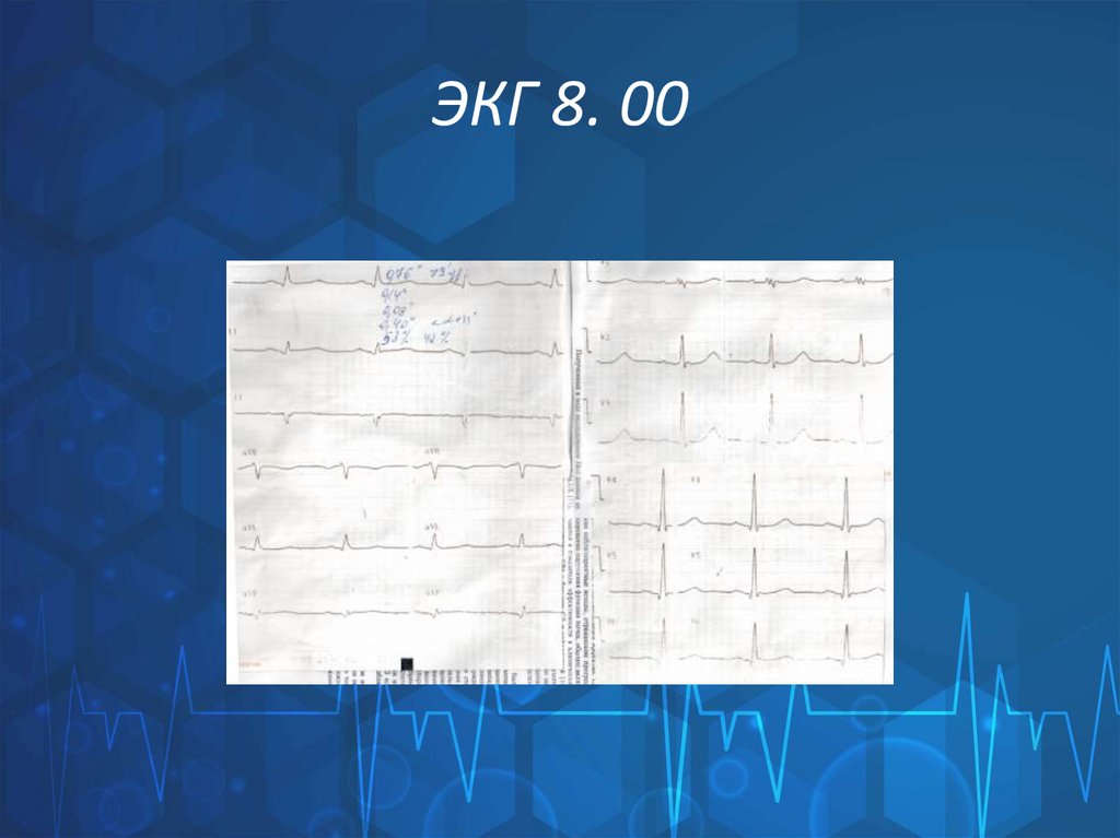 ЭКГ 8. 00