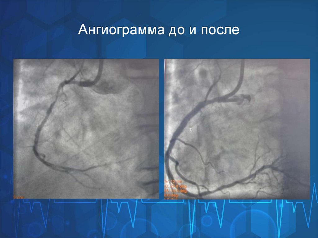 Ангиограмма до и после