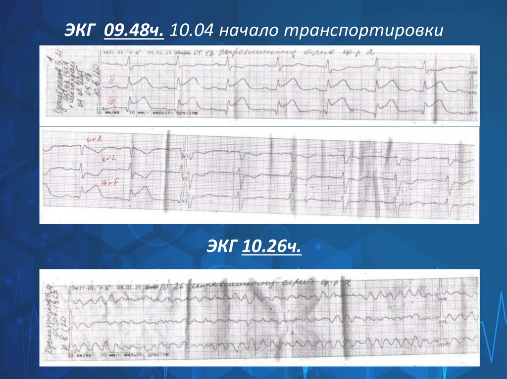 ЭКГ 09.48ч. 10.04 начало транспортировки