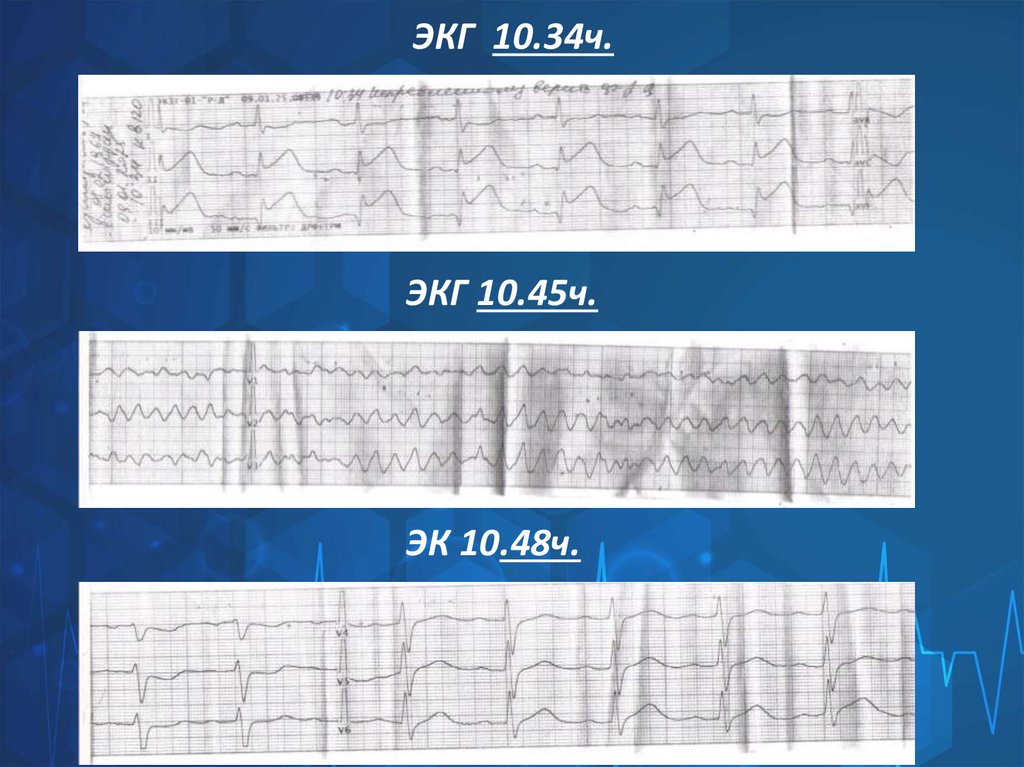 ЭКГ 10.34ч.