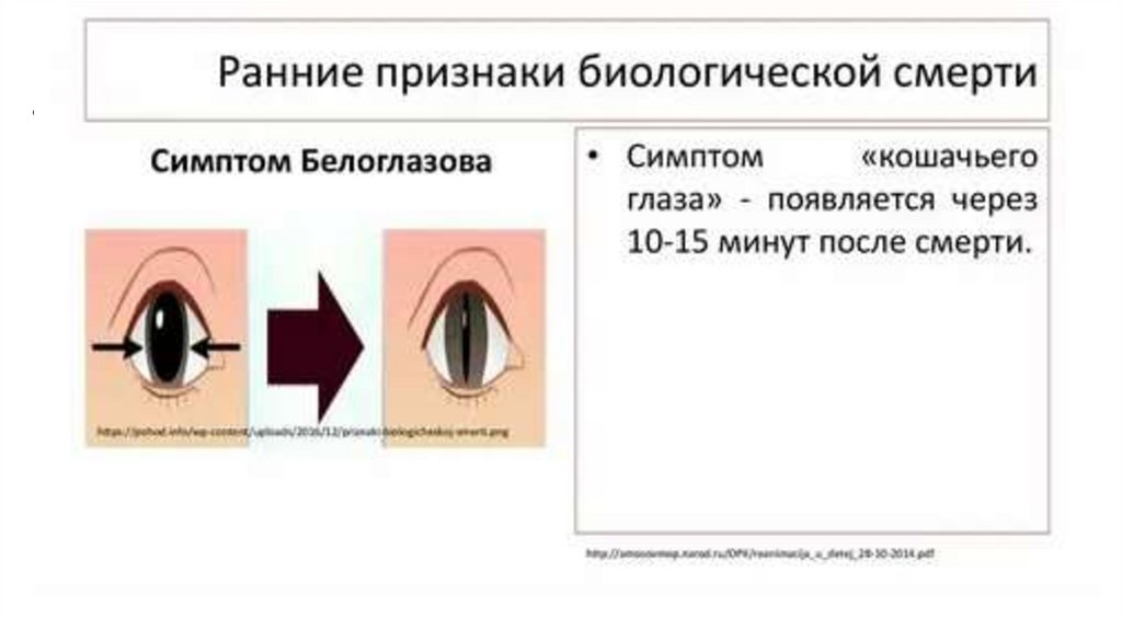 Симптом «кошачьего зрачка»
