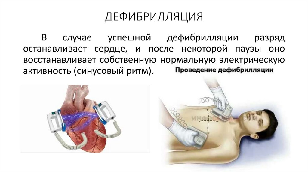 ДЕФИБРИЛЛЯЦИЯ