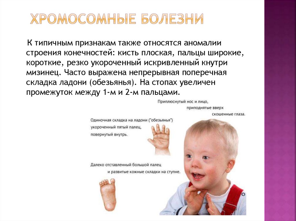 хромосомные болезни