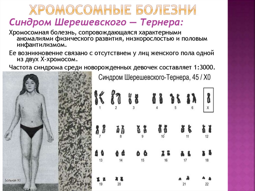 хромосомные болезни