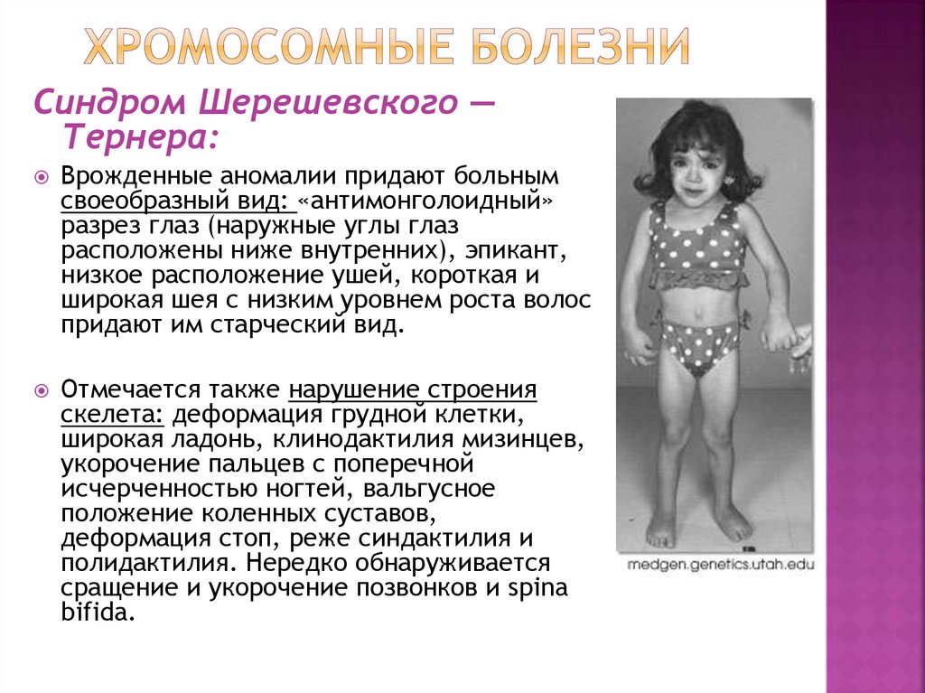 хромосомные болезни