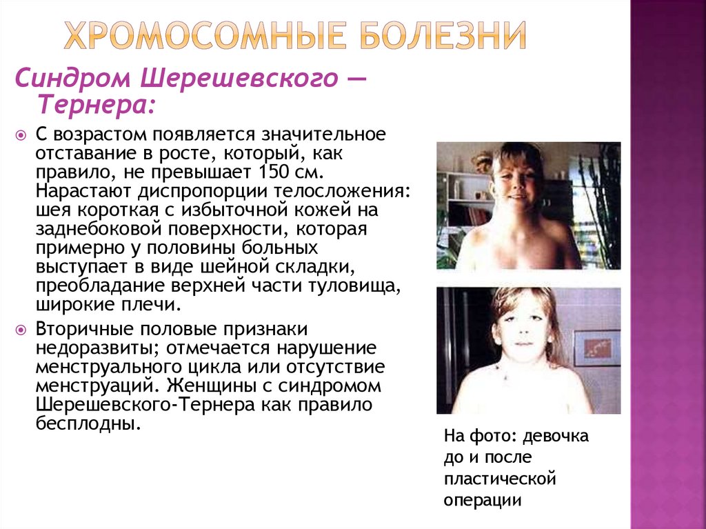 хромосомные болезни