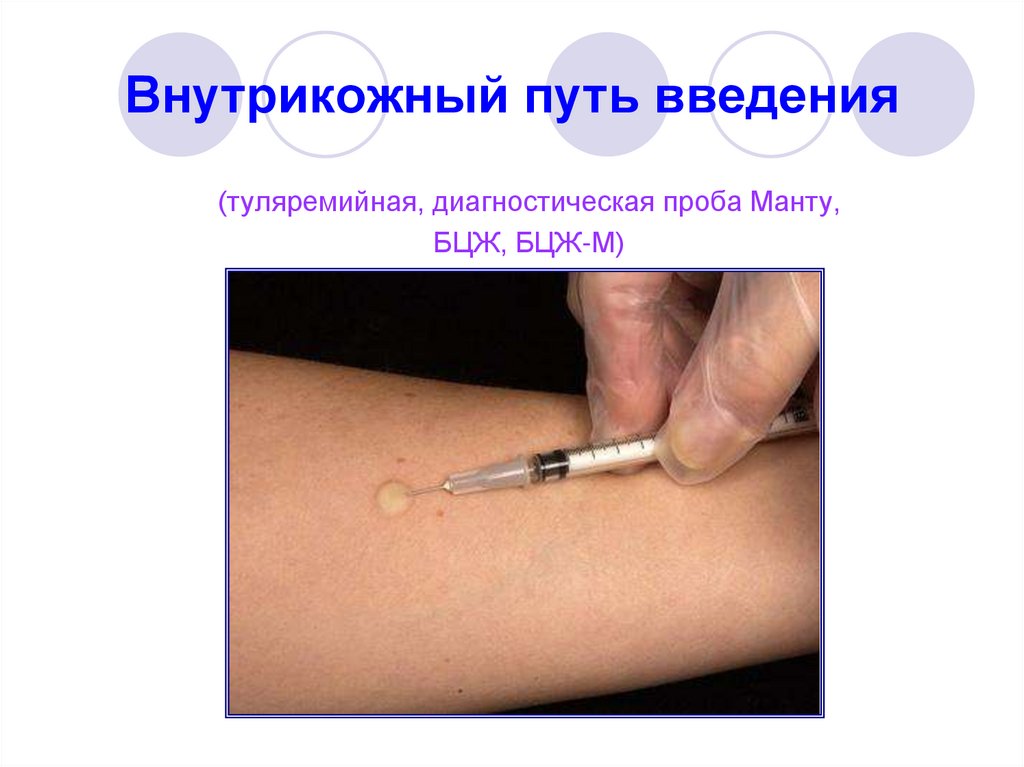 Внутрикожный путь введения