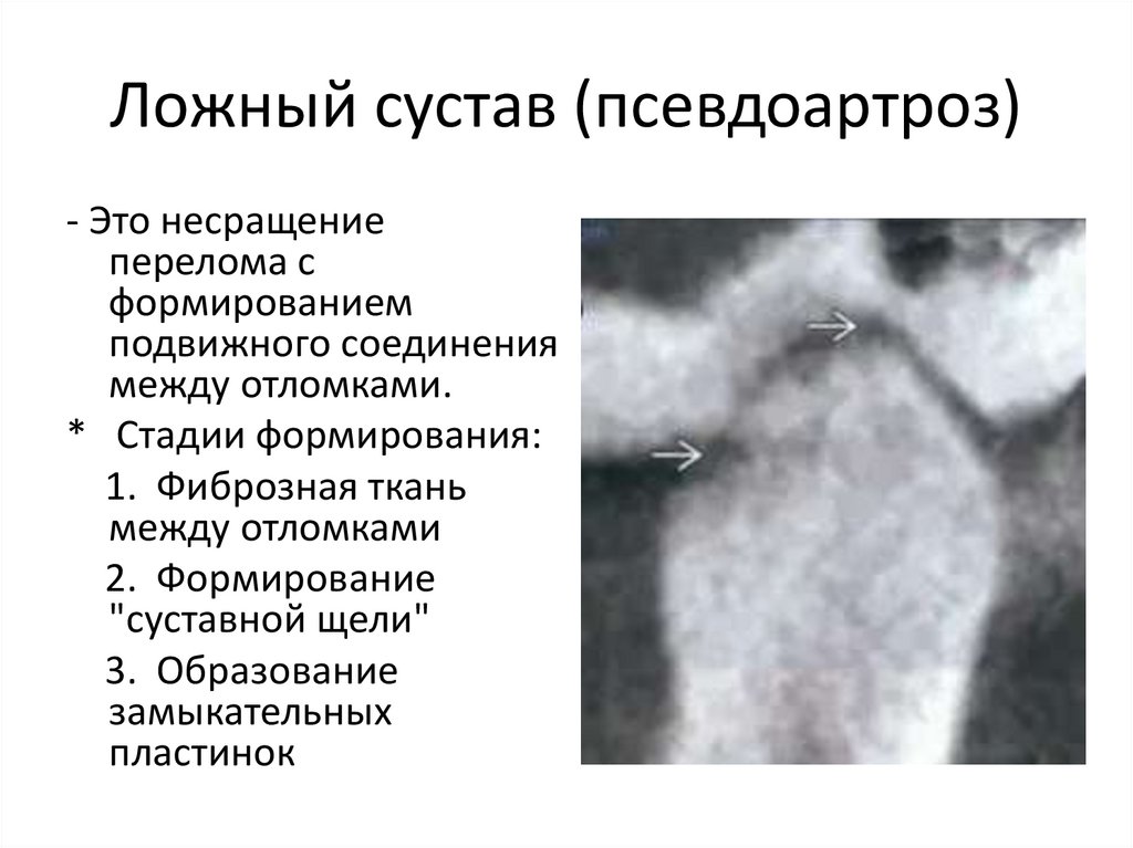 Ложный сустав (псевдоартроз)