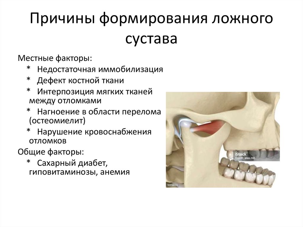 Причины формирования ложного сустава
