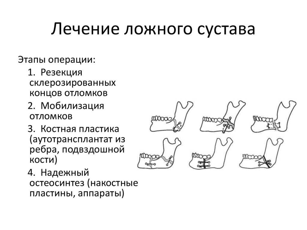Лечение ложного сустава