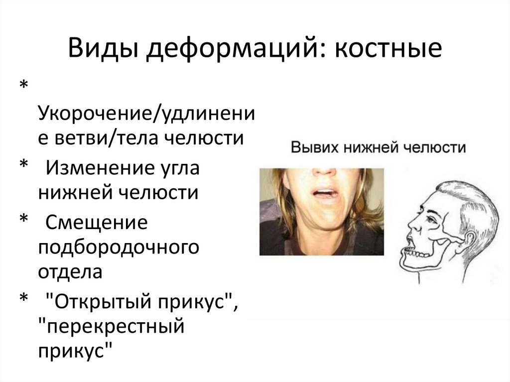 Виды деформаций: костные