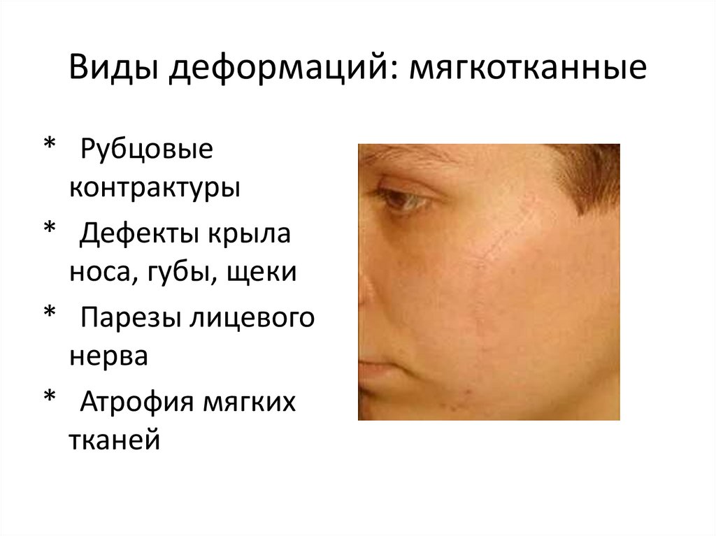 Виды деформаций: мягкотканные