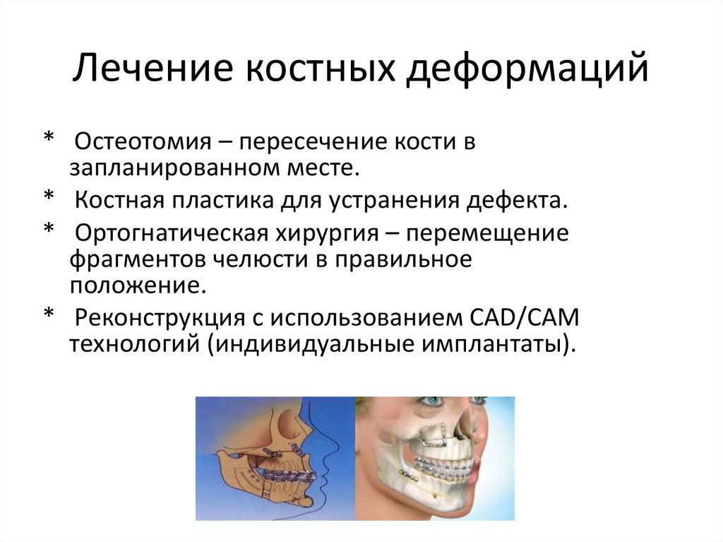 Лечение костных деформаций