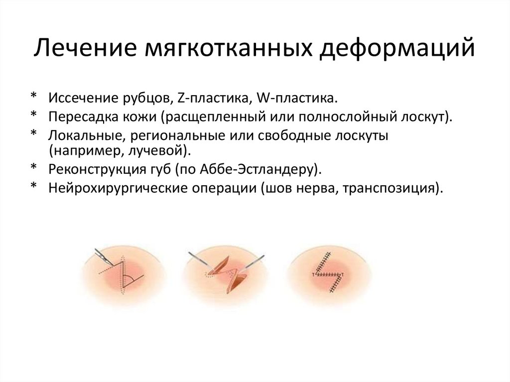 Лечение мягкотканных деформаций