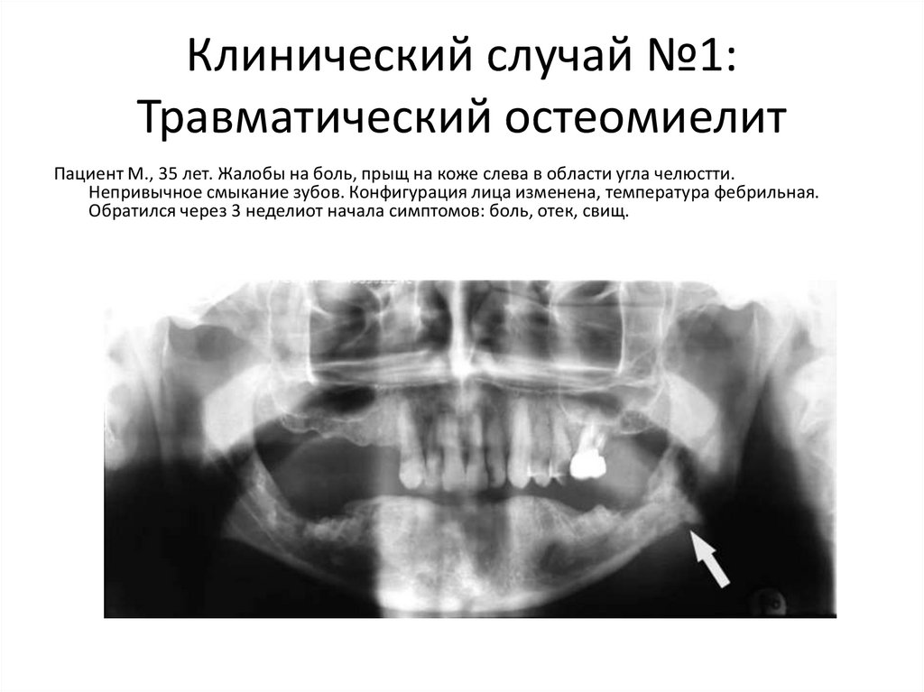 Клинический случай №1: Травматический остеомиелит