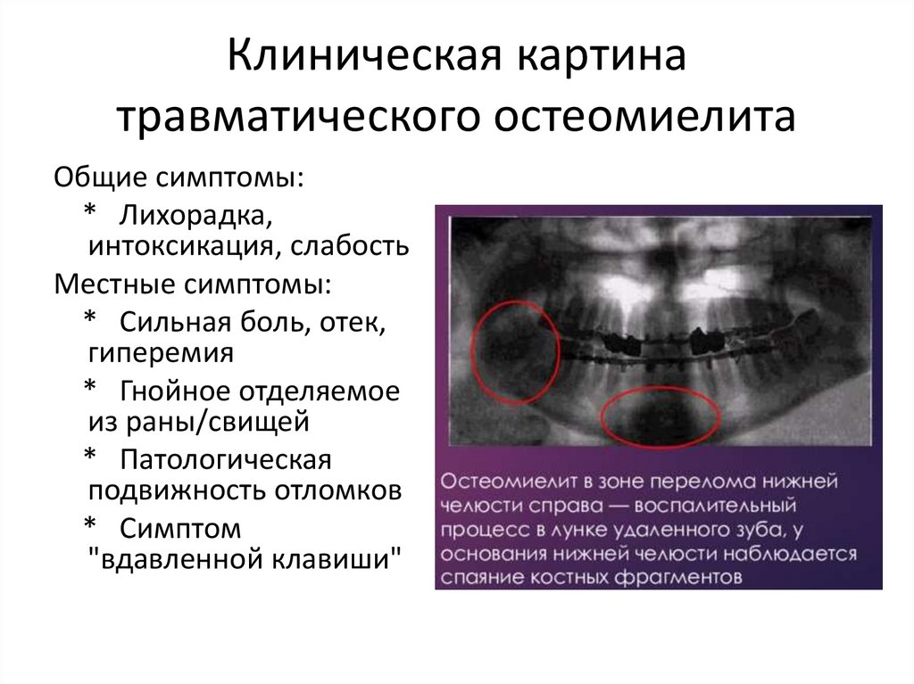 Клиническая картина травматического остеомиелита