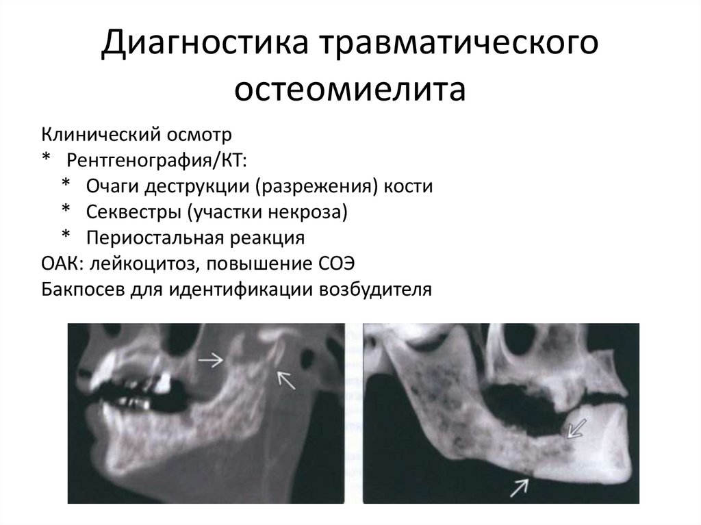 Диагностика травматического остеомиелита