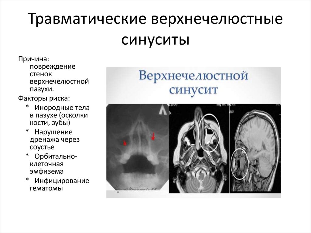 Травматические верхнечелюстные синуситы