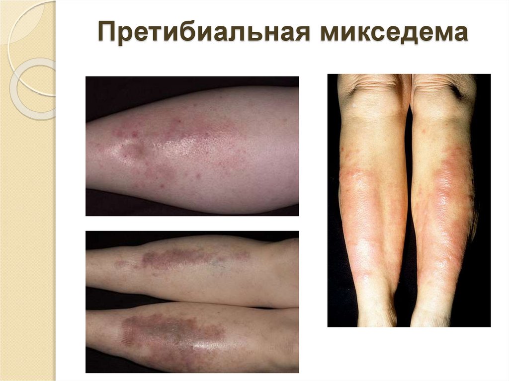 Претибиальная микседема