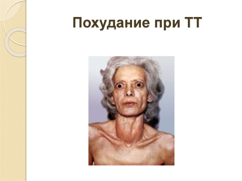 Похудание при ТТ