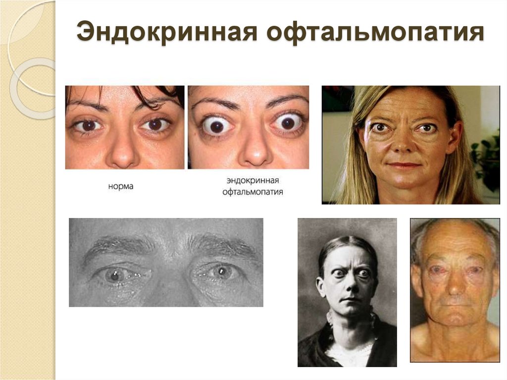 Эндокринная офтальмопатия