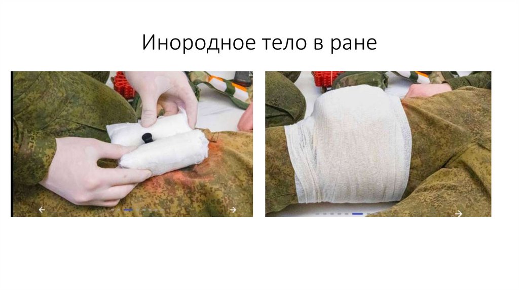 Инородное тело в ране