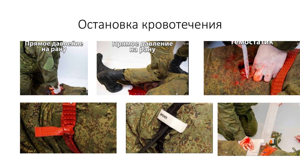 Остановка кровотечения