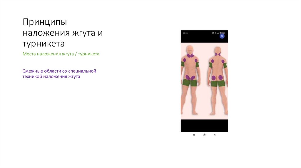 Принципы наложения жгута и турникета