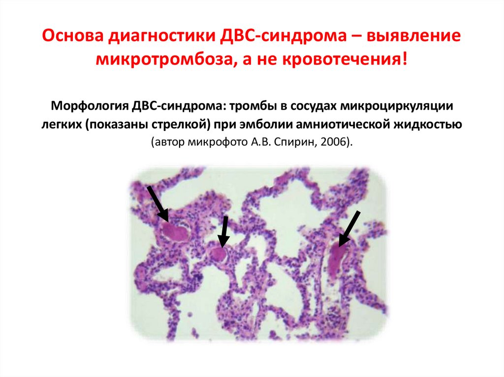 Основа диагностики ДВС-синдрома – выявление микротромбоза, а не кровотечения!