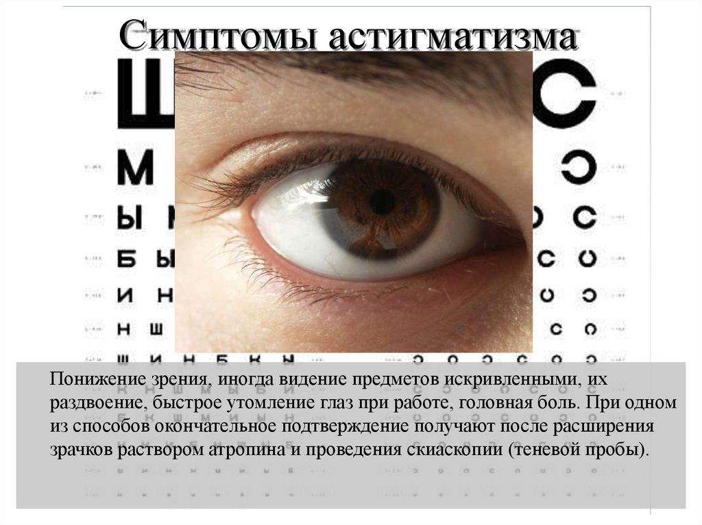 Симптомы астигматизма