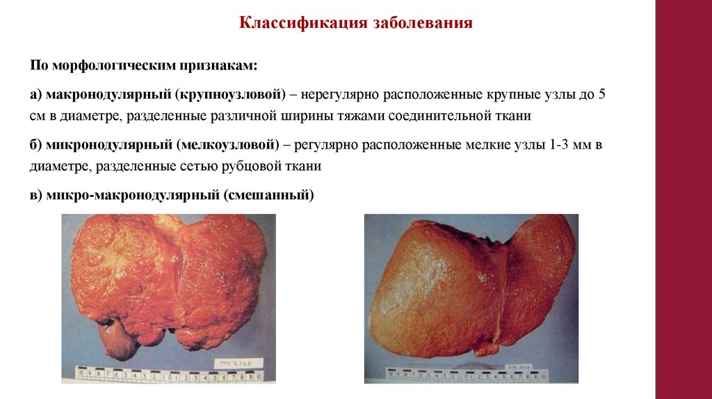 Классификация заболевания