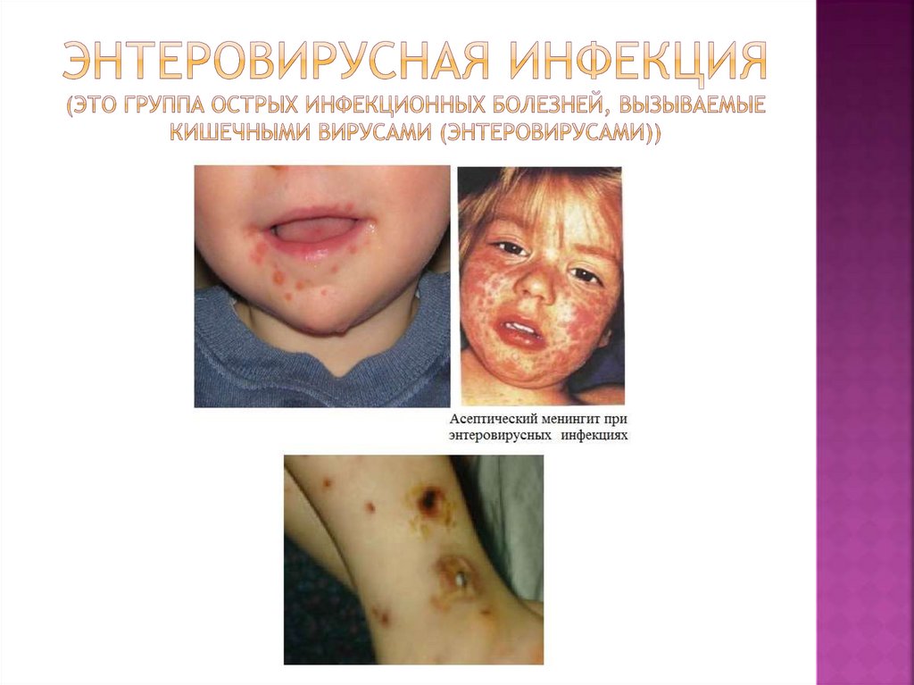 Энтеровирусная инфекция (это группа острых инфекционных болезней, вызываемые кишечными вирусами (энтеровирусами))