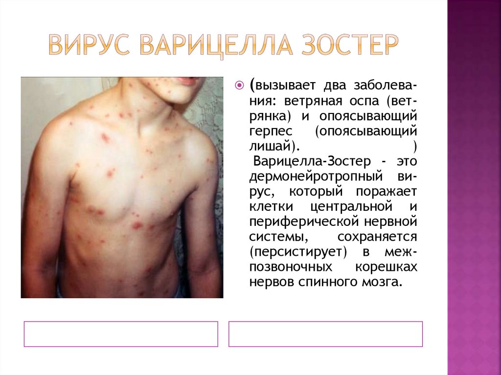 Вирус варицелла зостер