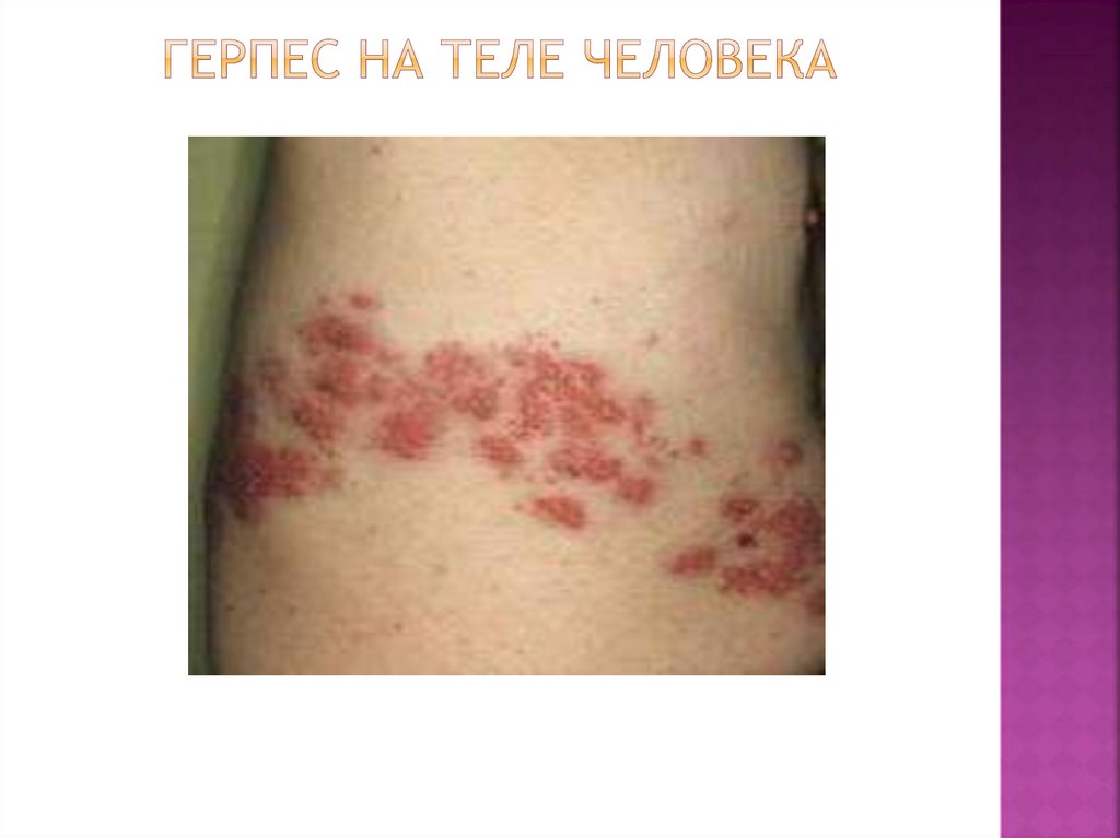 Герпес на теле человека
