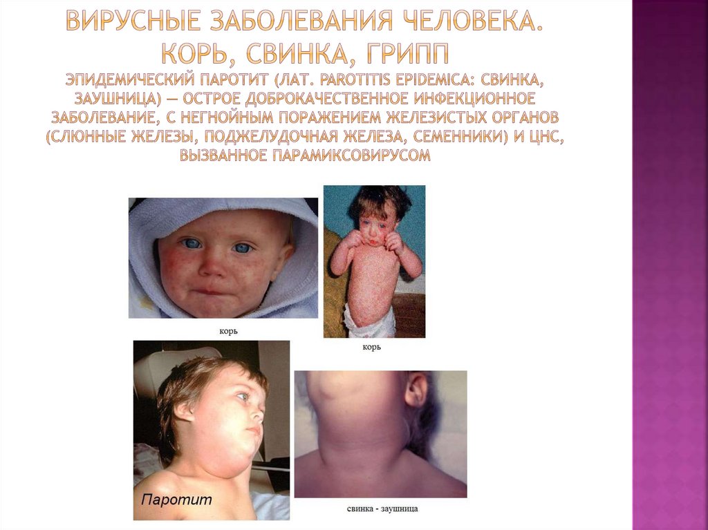 Вирусные заболевания человека. корь, свинка, грипп эпидемический паротит (лат. parotitis epidemica: свинка, заушница) — острое