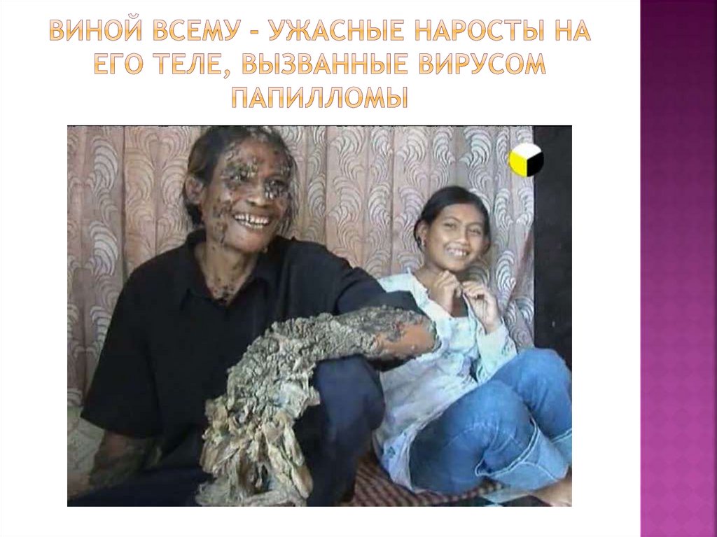 Виной всему - ужасные наросты на его теле, вызванные вирусом папилломы