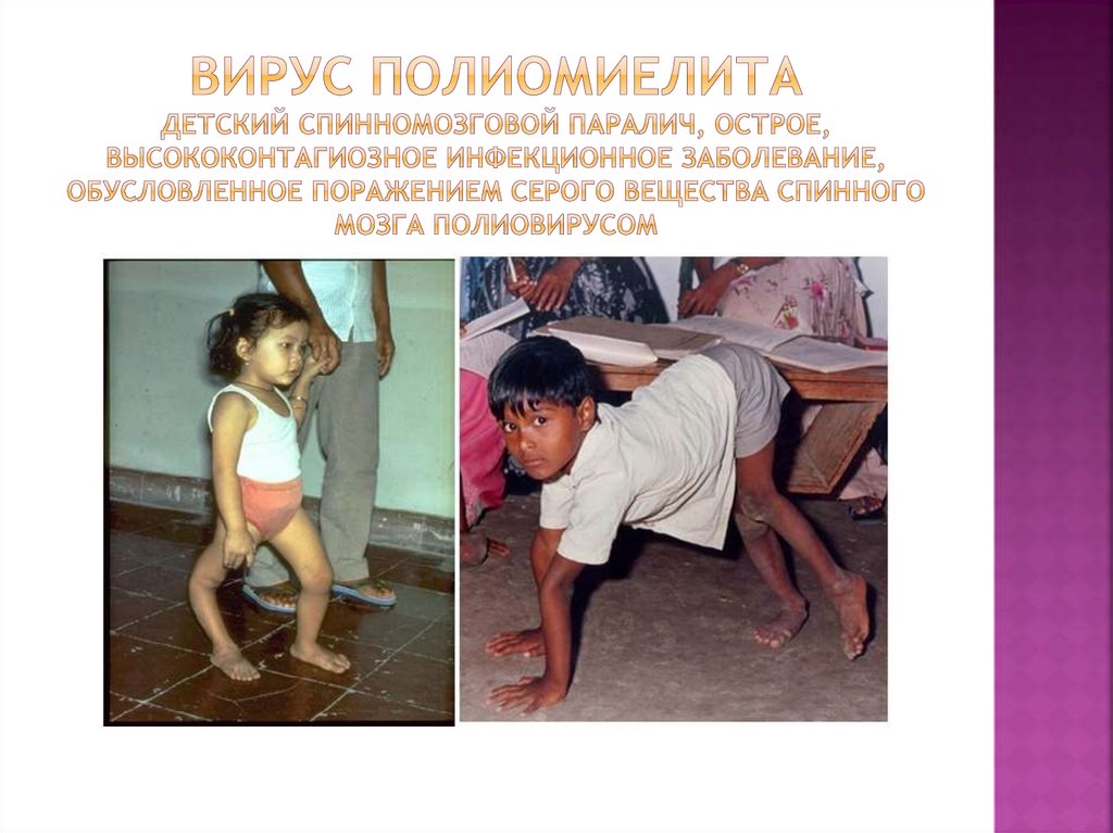 Вирус полиомиелита детский спинномозговой паралич, острое, высококонтагиозное инфекционное заболевание, обусловленное