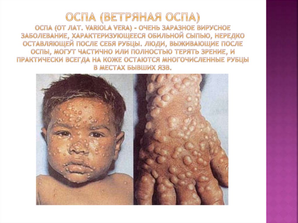 Оспа (ветряная оспа) Оспа (от лат. variola vera) - очень заразное вирусное заболевание, характеризующееся обильной сыпью,