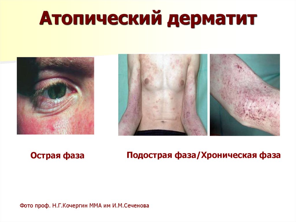 Атопический дерматит