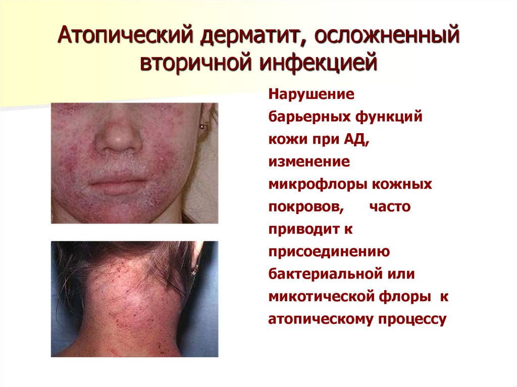 Атопический дерматит, осложненный вторичной инфекцией