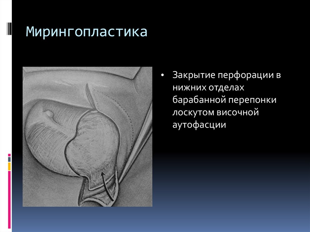 Мирингопластика