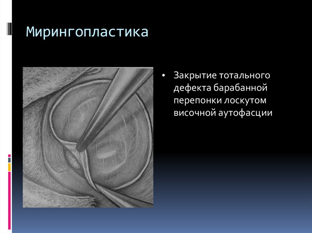 Мирингопластика