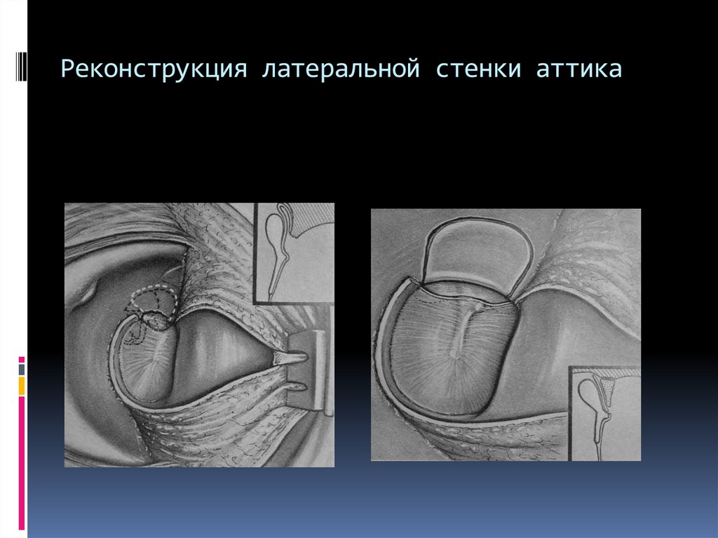 Реконструкция латеральной стенки аттика