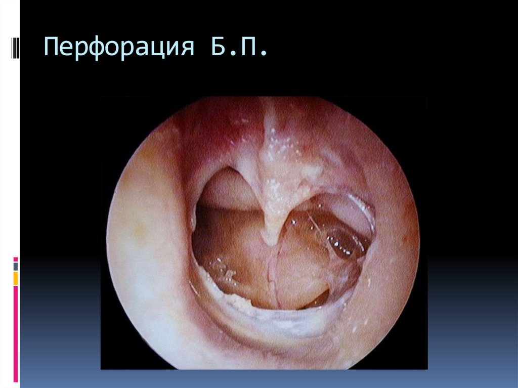 Перфорация Б.П.