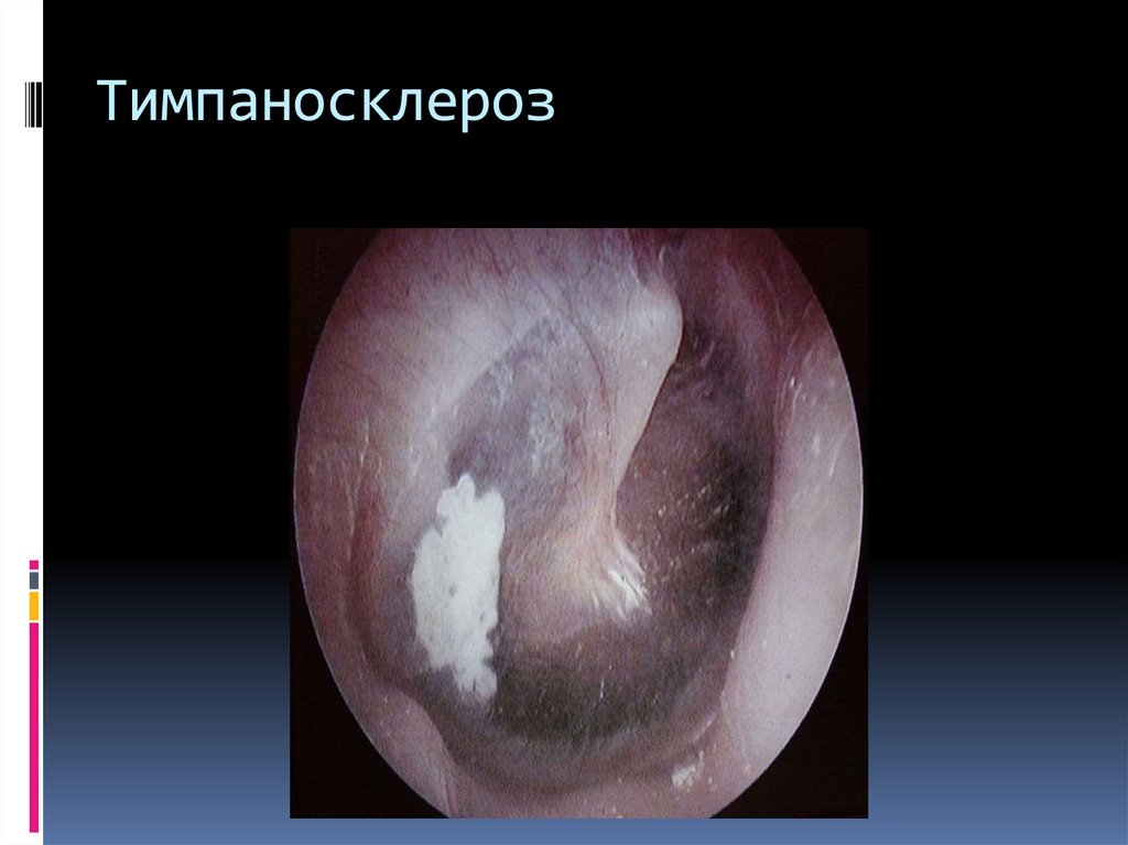 Тимпаносклероз