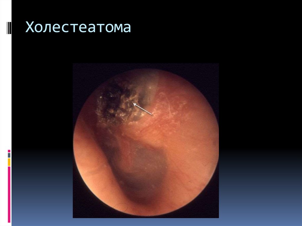 Холестеатома