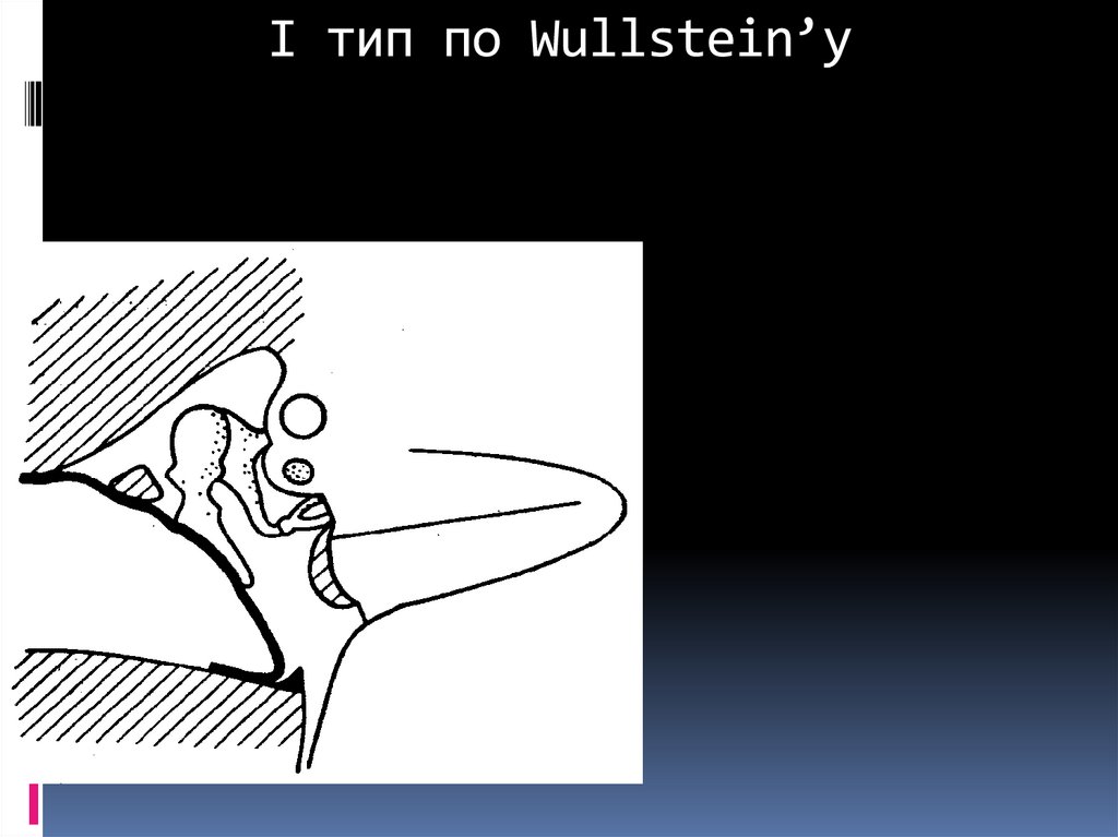 I тип по Wullstein’у